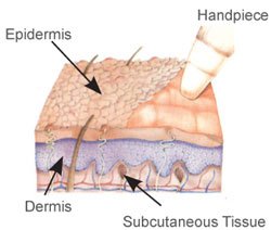 Microdermabration